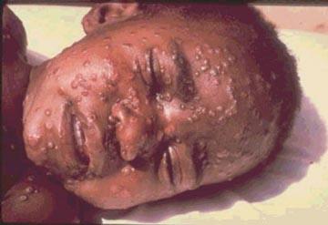 Smallpox face lesions on boy.  Photograph by Cheryl Tyron, Centers for Disease Control, Atlanta, Georgia.