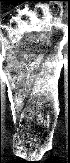 Cast made by Georgia police officer in 1997 of a 16.5 inch footprint found in woods after "large gorilla creature" reported. Print has same unusual vertical derma ridges similar to two other casts found in California and Washington State. The diagonal line is a cast artifact. Forensics expert Jimmy Chilcutt says the cast footprints he has studied are from "an animal of a different species that we haven't studied before."