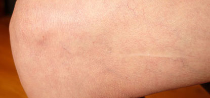 One of two pale, straight line scars from thin cuts by a white-coated presence that inserted a sharp instrument into the inside of a 2-year-old German girl's left and right legs. Image provided by experiencer.