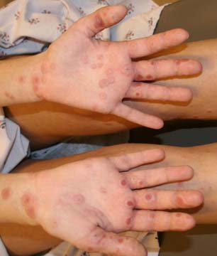 Child's hands with erythema multiforme (EM).
