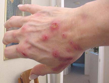 Morgellons lesions typically contain microscopic fibers that sufferers say are an agony of painful itching.
