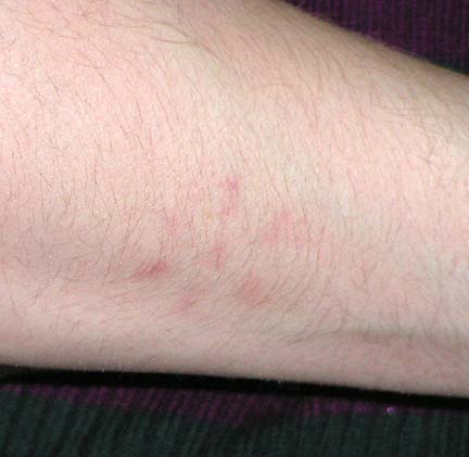 7-pointed geometric pattern in red discovered on right forearm of adult female after she saw a strange light in the night sky. Image courtesy female eyewitness.