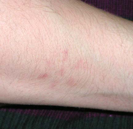 7-pointed geometric pattern in red discovered on right forearm of adult female after she saw a strange light in the night sky. Image courtesy female eyewitness.
