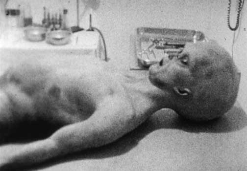One of two humanoids with six fingers and six toes in alleged 1947 autopsy footage filmed by U. S. military cameraman after extraterrestrial biological entities were retrieved from disc crash. Linda Moulton Howe was told the date was May 31, 1947, southeast of Aragon and 5 to 10 miles north of Elk Mountain at the western end of the Plains of San Agustin. Photographs provided by Ray Santilli, Merlin Productions, London, England © 1996 by Orbital Media Ltd.