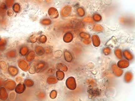 2001 summer, red and white cells collected from red rain that fell for first time on the state of Kerala, India. Photomicrograph © 2007 by Godfrey Louis, Ph.D.